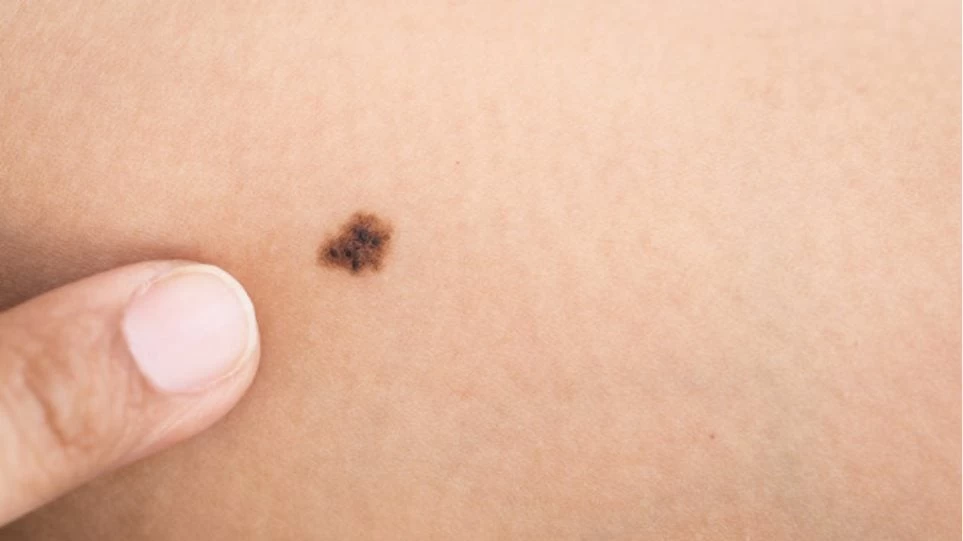 Kαρκίνος του δέρματος: Αυτά τα άτομα διατρέχουν μεγαλύτερο κίνδυνο